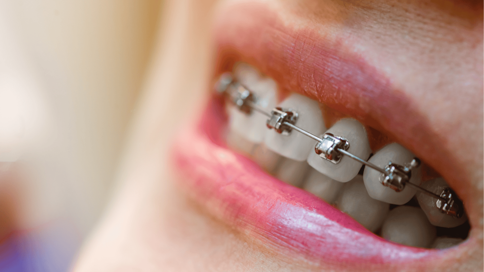 What Happens After Braces Come Off? Your Post-Treatment Guide